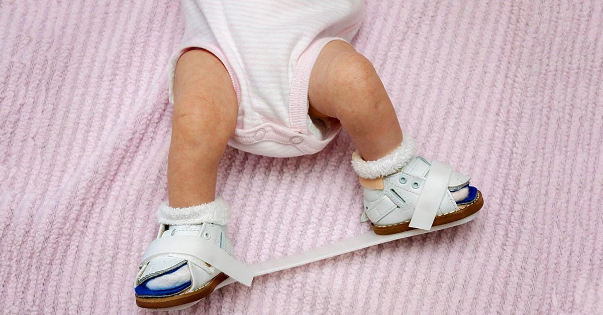 Ponseti Clubfoot Boots and Bar Karachi